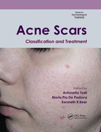 Acne Scars: Classification and Treatment