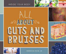 All about Cuts and Bruises