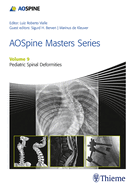 Aospine Masters Series, Volume 9: Pediatric Spinal Deformities Xyz