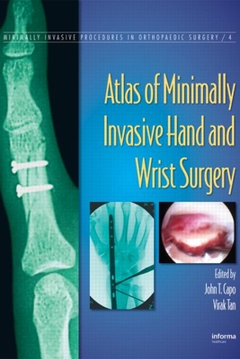 Atlas of Minimally Invasive Hand and Wrist Surgery - Capo, John T. (Editor), and Tan, Virak (Editor)