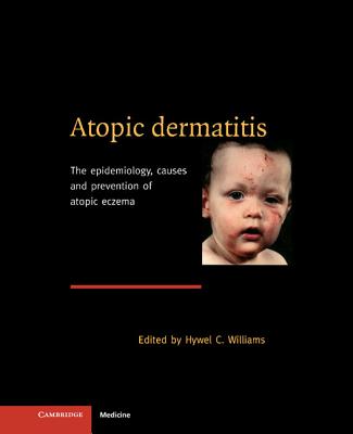 Atopic Dermatitis: The Epidemiology, Causes and Prevention of Atopic Eczema - Williams, Hywel C (Editor)