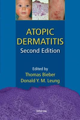 Atopic Dermatitis - Bieber, Thomas (Editor), and Leung, Donald Y M (Editor)