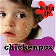 Chicken Pox - Powell, Jillian