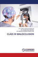 Class III Malocclusion
