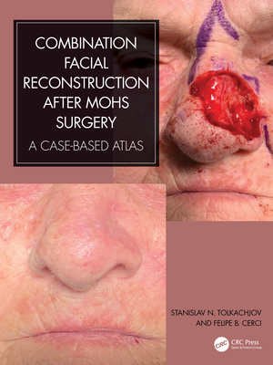 Combination Facial Reconstruction After Mohs Surgery: A Case Based Atlas - Tolkachjov, Stanislav N, and Cerci, Felipe B