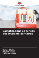 Complications et ?checs des implants dentaires