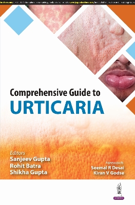 Comprehensive Guide to Urticaria - Gupta, Sanjeev, and Batra, Rohit, and Gupta, Shikha