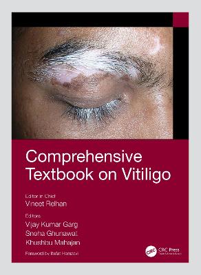 Comprehensive Textbook on Vitiligo - Relhan, Vineet (Editor), and Garg, Vijay Kumar (Editor), and Ghunawat, Sneha (Editor)