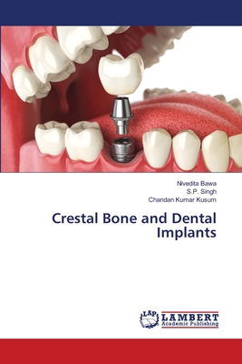 Crestal Bone and Dental Implants - Bawa, Nivedita, and Singh, S P, and Kumar Kusum, Chandan