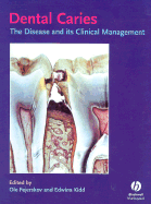 Dental Caries - Fejerskoy, Ole (Editor), and Kidd, Edwina (Editor)