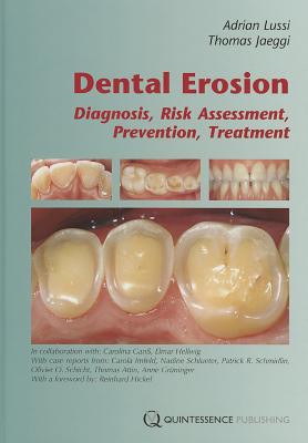 Dental Erosion - Lussi, Adrian, and Jaeggi, Thomas