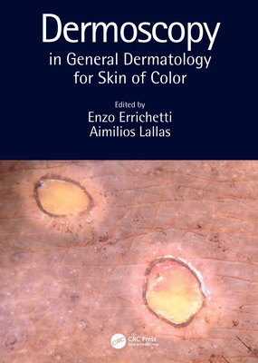 Dermoscopy in General Dermatology for Skin of Color - Errichetti, Enzo (Editor), and Lallas, Aimilios (Editor)