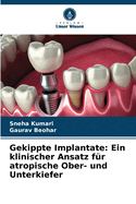 Gekippte Implantate: Ein klinischer Ansatz f?r atropische Ober- und Unterkiefer