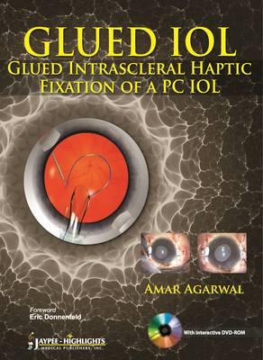 GLUED IOL: Glued Intrascleral Haptic Fixation of a PC IOL - Agarwal, Amar