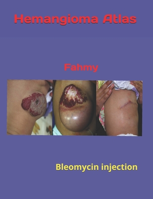 Hemangioma Atles: Bleomycin injection - Fahmy, Mohamed A Baky