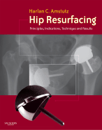 Hip Resurfacing: Principles, Indications, Technique and Results