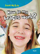 How do my Braces Work? - Parker, Steve