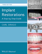 Implant Restorations: A Step-By-Step Guide