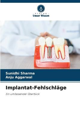 Implantat-Fehlschl?ge - Sharma, Sunidhi, and Aggarwal, Anju