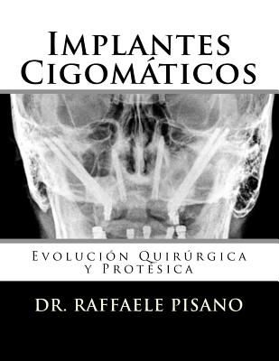 Implantes Cigomticos: Evoluci?n Quirrgica y Prot?sica - Pisano, Raffaele