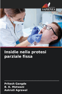 Insidie nella protesi parziale fissa