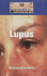 Lupus