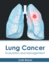 Lung Cancer: Evaluation and Management