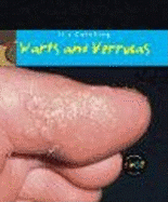 It's Catching: Warts and Verrucas