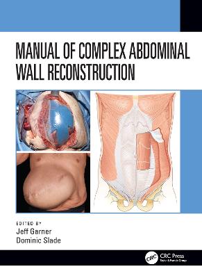Manual of Complex Abdominal Wall Reconstruction - Garner, Jeff (Editor), and Slade, Dominic (Editor)