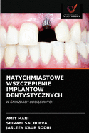 Natychmiastowe Wszczepienie Implant?w Dentystycznych