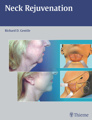 Neck Rejuvenation - Gentile, Richard D (Editor)