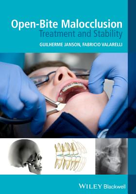 Open-Bite Malocclusion: Treatment and Stability - Janson, Guilherme (Editor), and Valarelli, Fabricio (Editor)