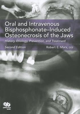 Oral and Intravenous Bisphosphonate-Induced Osteonecrosis of the Jaws: History, Etiology, Prevention, and Treatment - Marx, Robert E