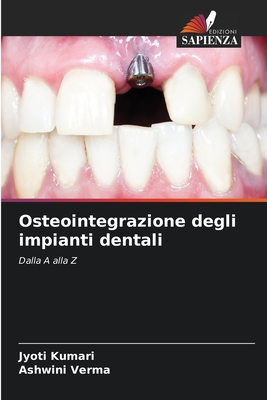 Osteointegrazione degli impianti dentali - Kumari, Jyoti, and Verma, Ashwini