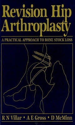 Revision Hip Arthroplasty: A Practical Approach to Bone Stock Loss - Villar, Richard N (Editor), and Gross, Allan E (Editor), and McMinn, Derek (Editor)