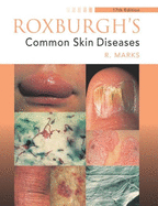 Roxburgh's Common Skin Diseases