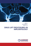 Sinus Lift Procedures in Implantology