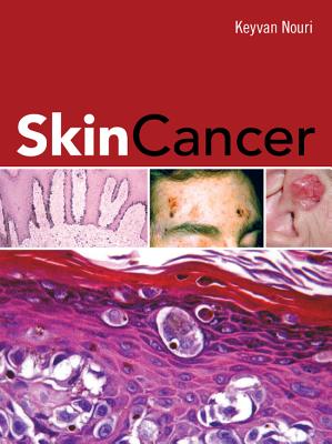 Skin Cancer - Nouri, Keyvan