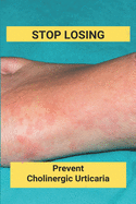 Stop Losing: Prevent Cholinergic Urticaria: Losing Itchy Hair