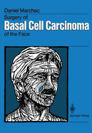 Surgery of Basal Cell Carcinoma of the Face