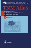 Tnm Atlas: Illustrated Guide to the Tnm/Ptnm Classification of Malignant Tumours