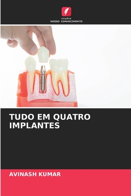 Tudo Em Quatro Implantes - Kumar, Avinash