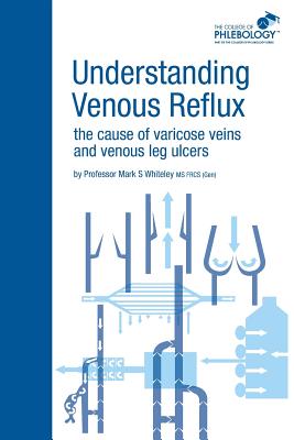 Understanding Venous Reflux the Cause of Varicose Veins and Venous Leg Ulcers - Whiteley, Mark S.