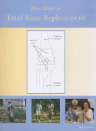 Your Guide to Total Knee Replacement
